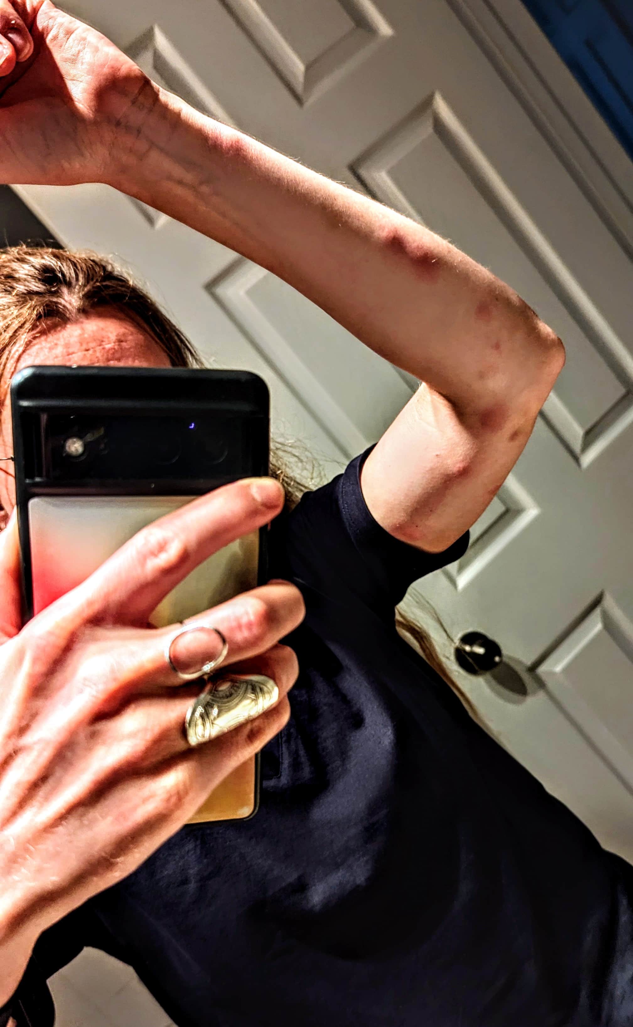 [PHOTOS] Airbnb infesté de punaises de lit à Montréal couverte de piqûres, une jeune Française