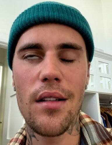 Justin Bieber gibt bekannt, dass er halbseitig gelähmt ist