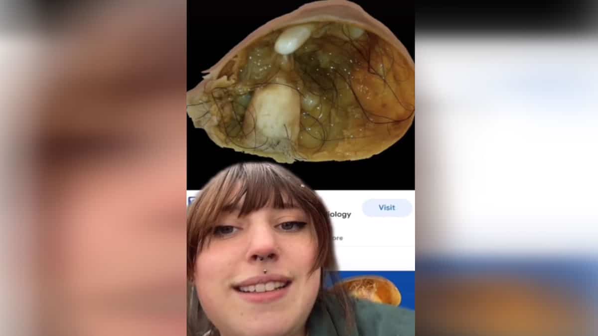 Des Poils Et Des Dents Poussent Dans Son Uterus Tva Nouvelles Des Poils Et Des Dents Poussent Dans Son Uterus Tva Nouvelles