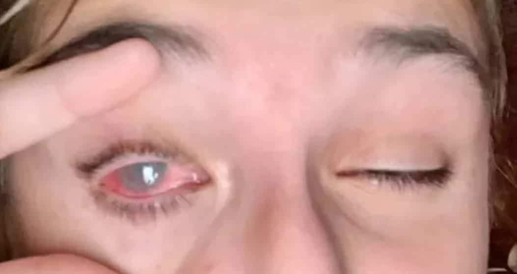 She is blind in one eye by coloring her hair