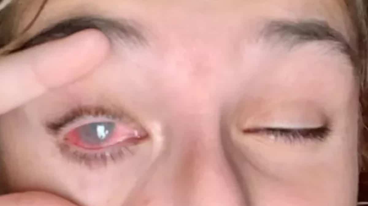 She is blind in one eye by coloring her hair She is blind in one eye by coloring her hair