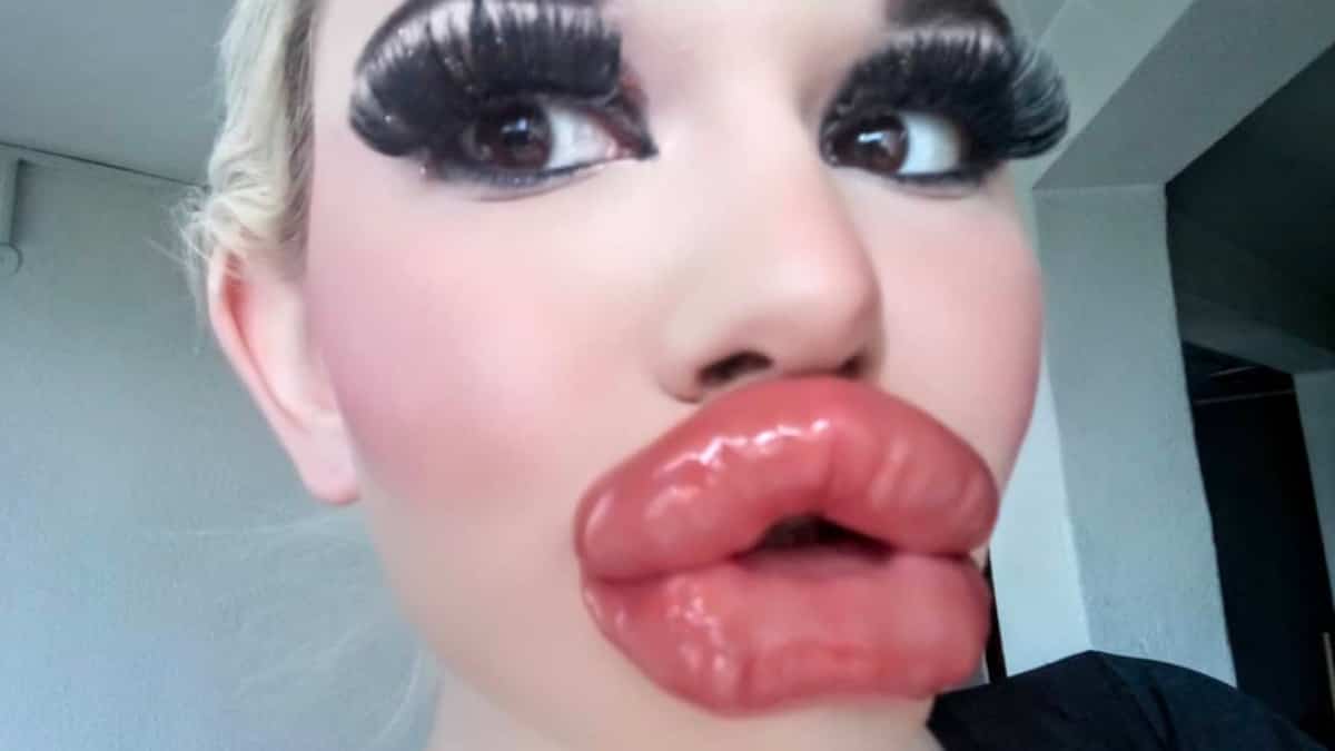 La Femme Aux Plus Grosses Levres Du Monde Fait Encore Grossir Ses Levres