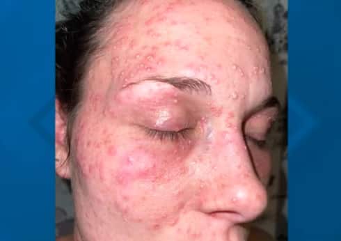 Visage maintenu dans un nid de fourmis rouges: une m&egrave;re poursuit la police de Sante Fe