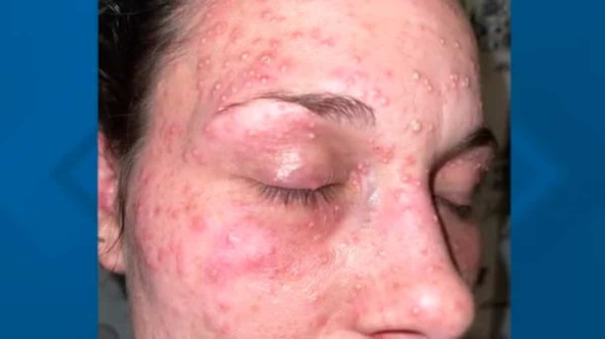 Visage maintenu dans un nid de fourmis rouges: une mère poursuit la police de Sante Fe