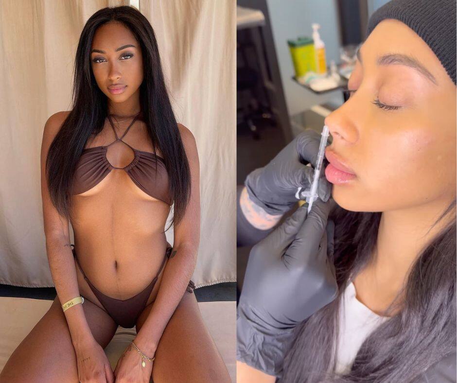 Anna-Maëlle dévoile le résultat de ses injections