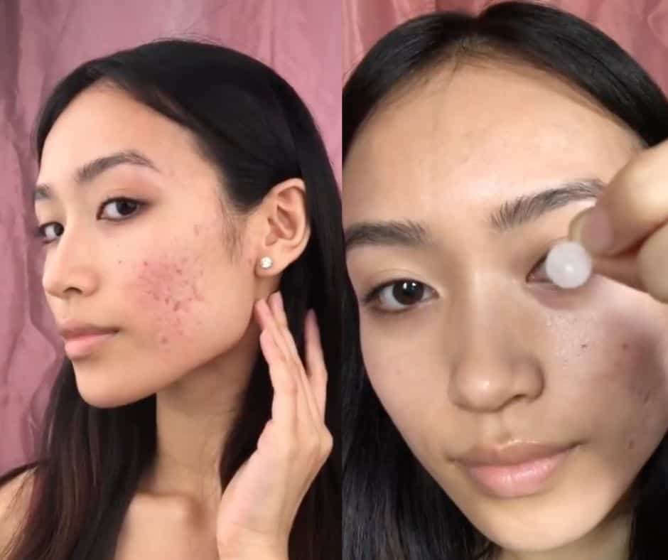 Ces patchs anti-bouton sont virales sur TikTok