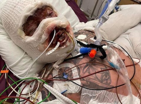 Olivier Marchand was in a coma for three months after the fire.