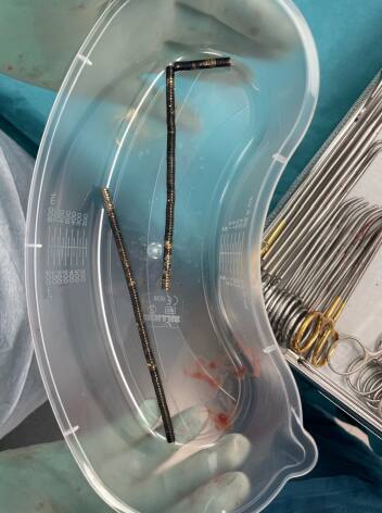 Surgeons Extract 100 Magnets from Teen's Gut in New Zealand Medical Marvel