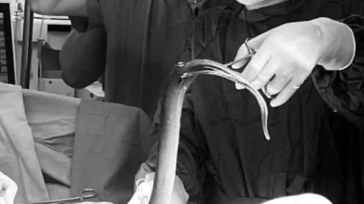 Un homme hospitalisé après s’être rentré une anguille vivante de 65 cm dans le postérieur