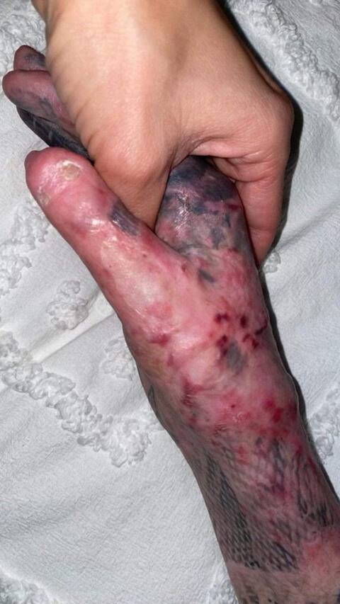 Oliver Marchand's hands were particularly affected by the fire.