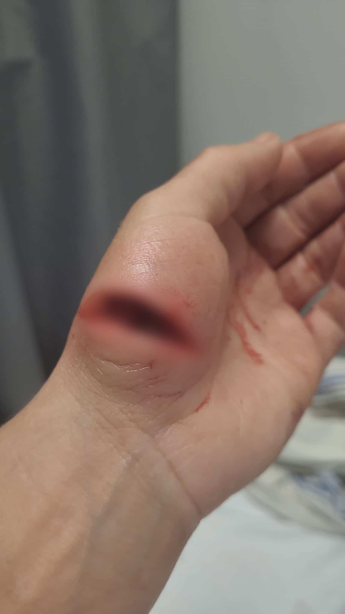 Sylvie Nault s'est servie de sa main pour se protéger le visage lors de l'attaque au couteau. Le Journal a flouté la blessure.