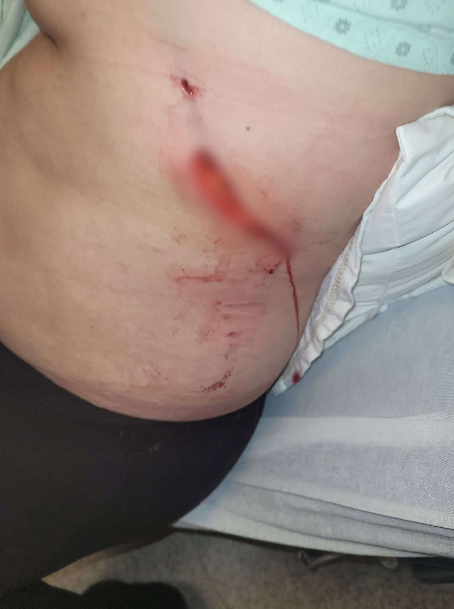 Sylvie Nault a aussi été lacérée de 5 à 6 centimètres de profondeur, près des côtes. Le Journal a flouté la blessure.
