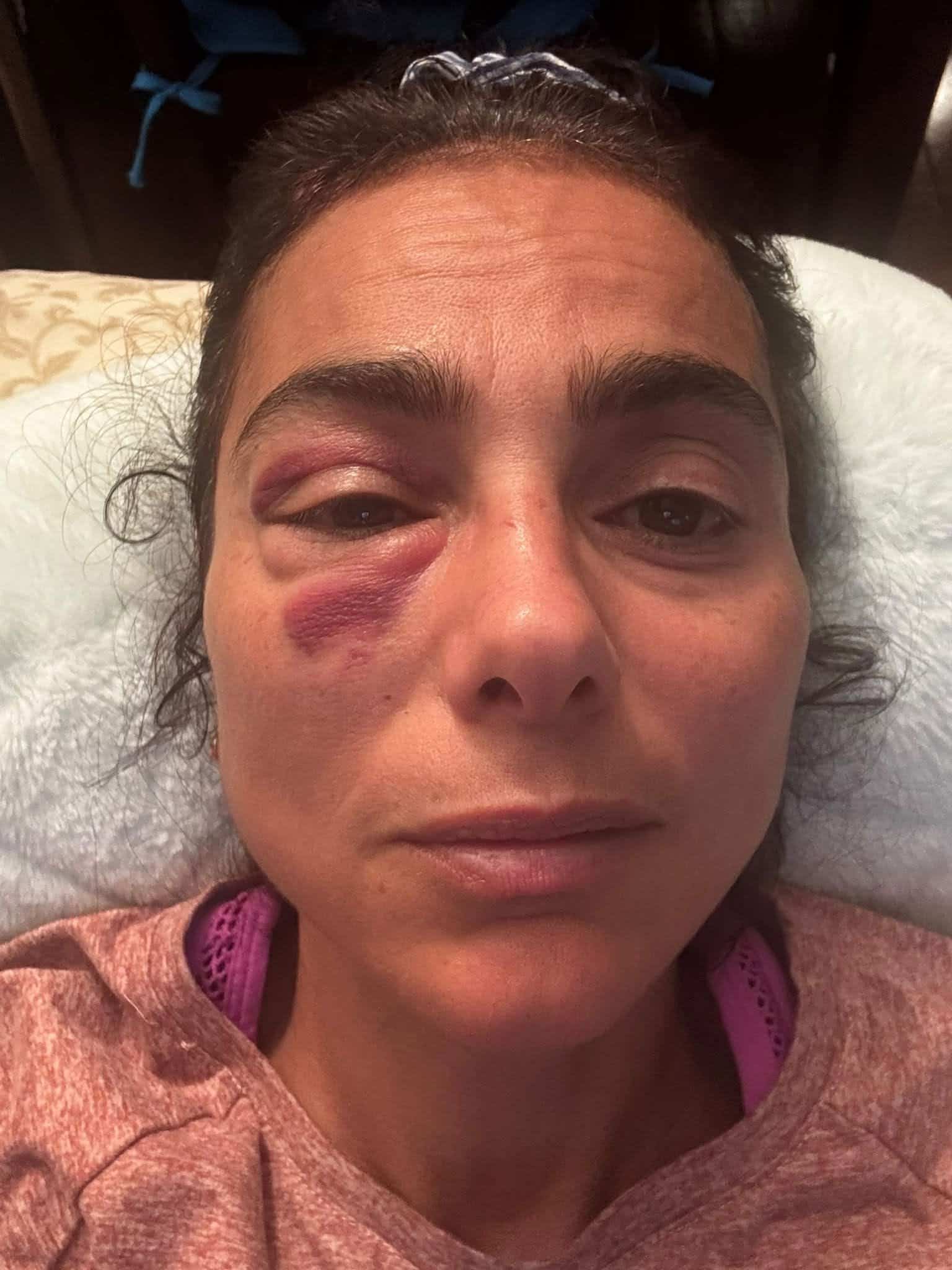 L’impact avec son petit-fils de 5 ans a causé une commotion cérébrale sévère à Layla Bakir, en plus d’une fracture du plancher orbital.