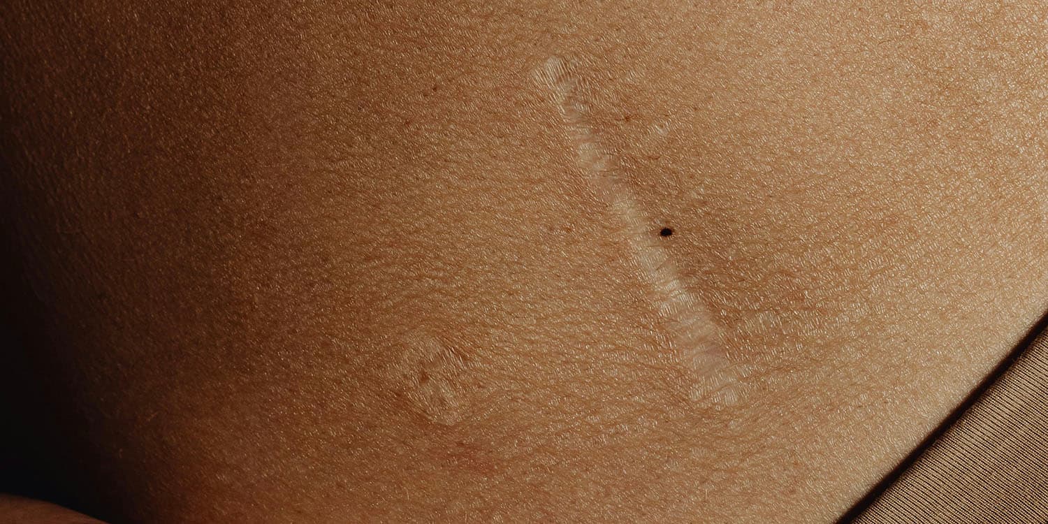 Prendre soin d’une cicatrice de césarienne