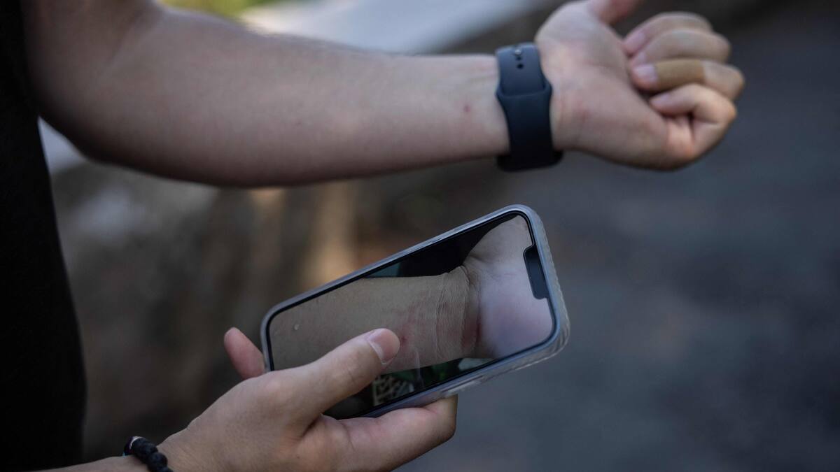 Deux premiers décès liés à la variole du singe hors d’Afrique