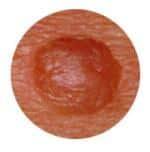 Grain De Beaute Qui Se Transforme En Croute
