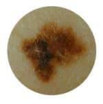 Les types de grains de beauté et comment identifier ceux qui pourraient — free download