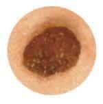 Les types de grains de beauté et comment identifier ceux qui pourraient — free download