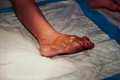 Foto de las quemaduras de la víctima del incendio por el que se acusa a Jason Pothier-Martin. El acusado supuestamente lanzó dos cócteles Molotov en un apartamento de Lévis el 20 de agosto de 2022, y los objetos incendiarios cayeron en un dormitorio donde dormían dos niños. Una niña de 3 años sufrió heridas graves en el incidente, incluidas quemaduras de tercer grado en el pie.