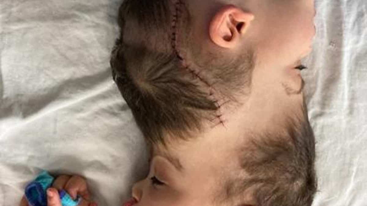 Brésil: des jumeaux siamois séparés à l'aide de la réalité virtuelle