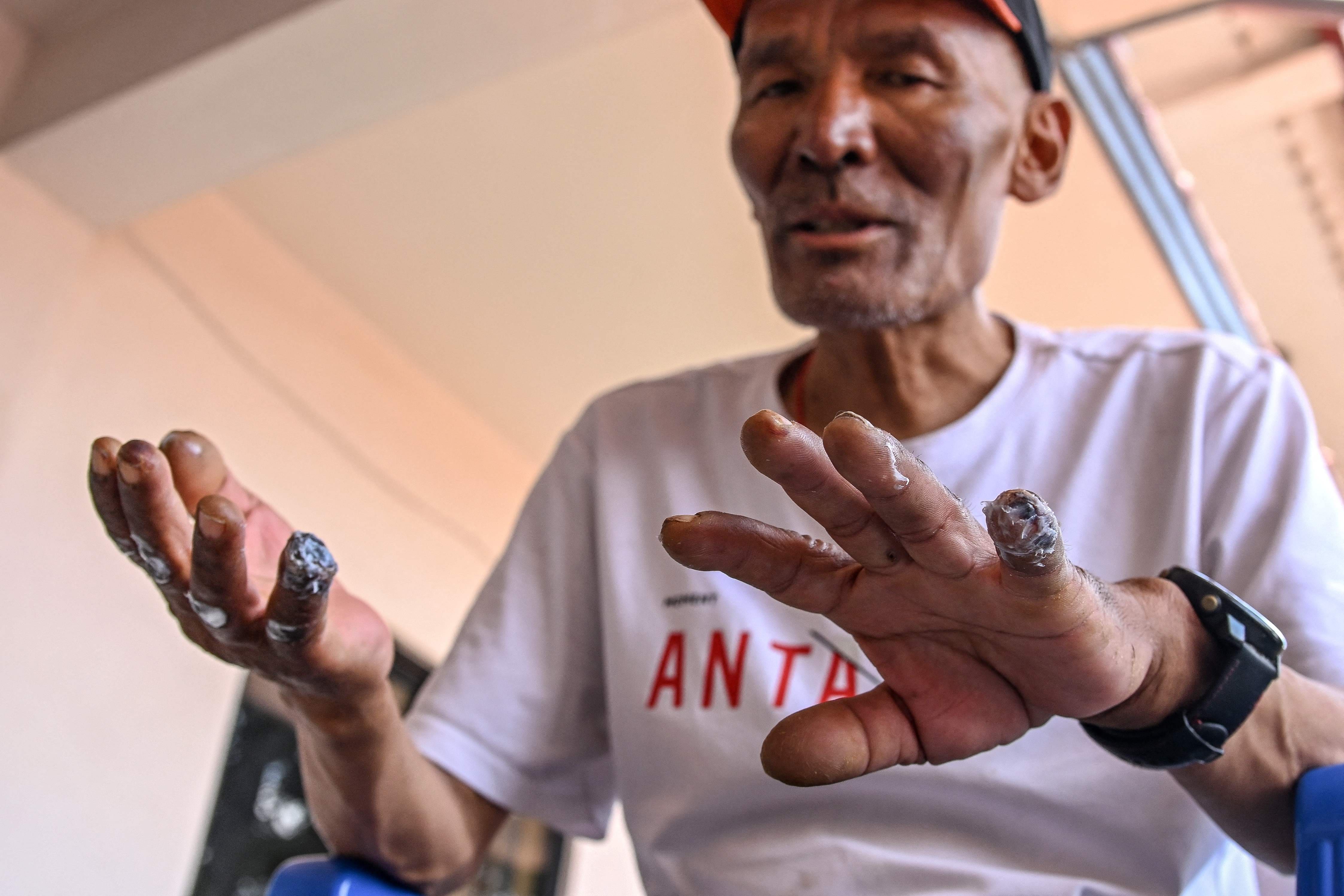 Le survivant de l'Everest Dawa Sherpa montre ses mains gelées lors d'une interview accordée à l'AFP à Katmandou le 18 juin 2026.