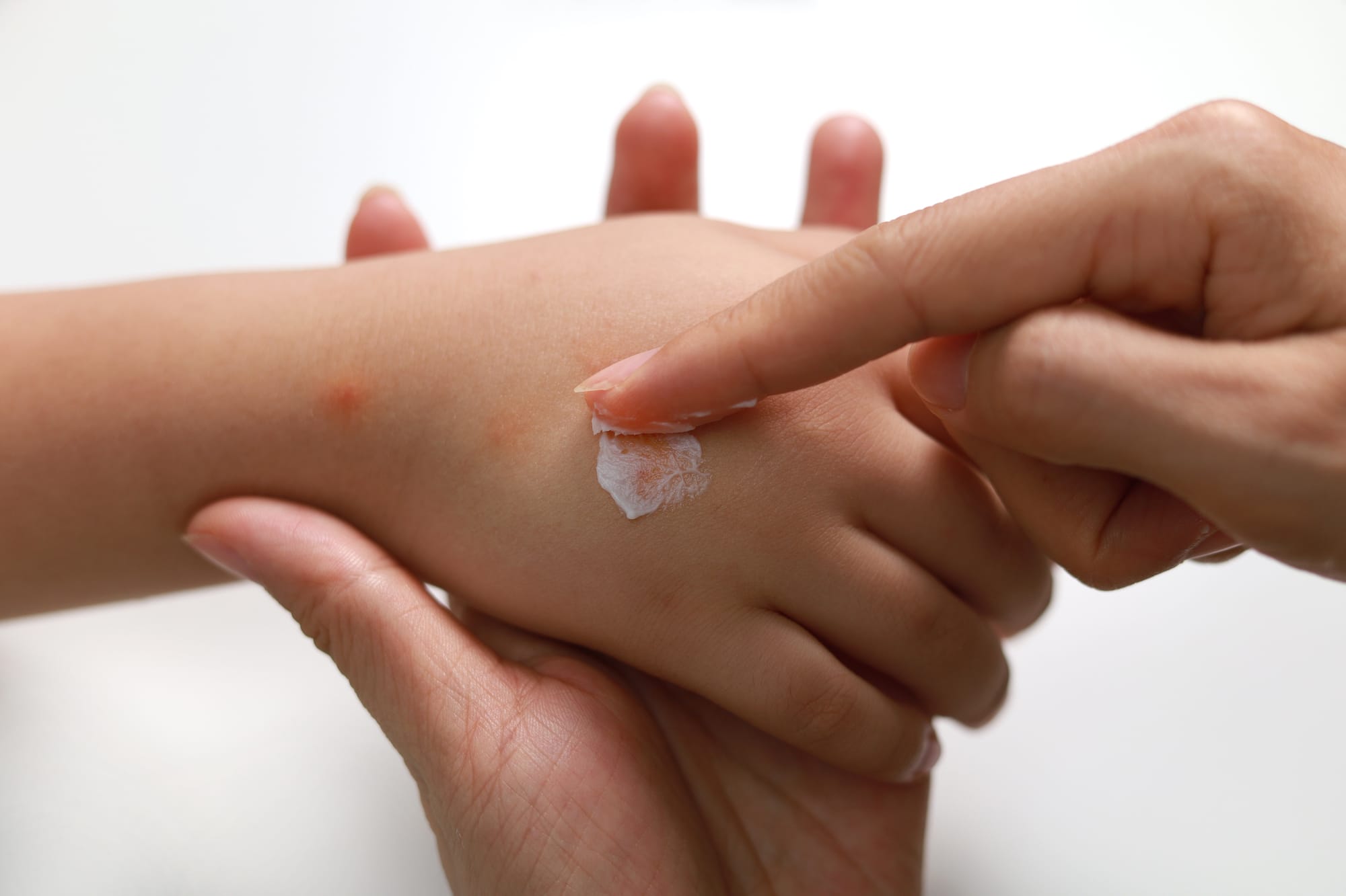 Piqures Et Morsures D Insectes Petit Guide Pour Les Prevenir Et Les Traiter Jdm