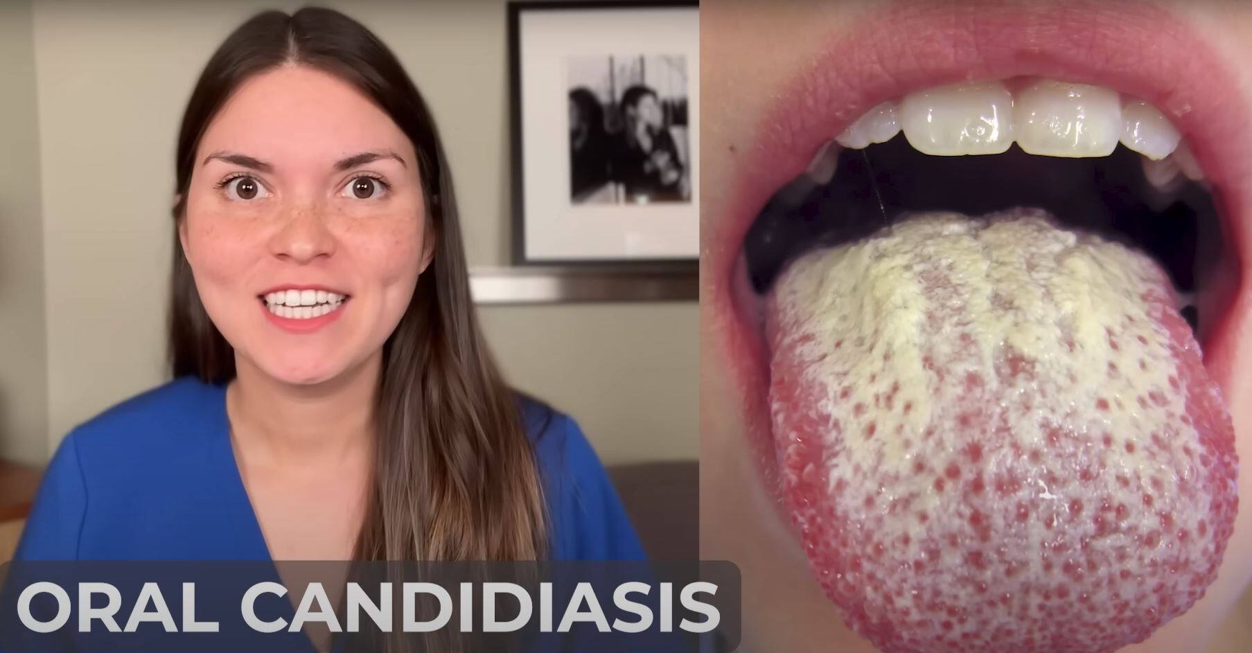 cancer de la langue blanche