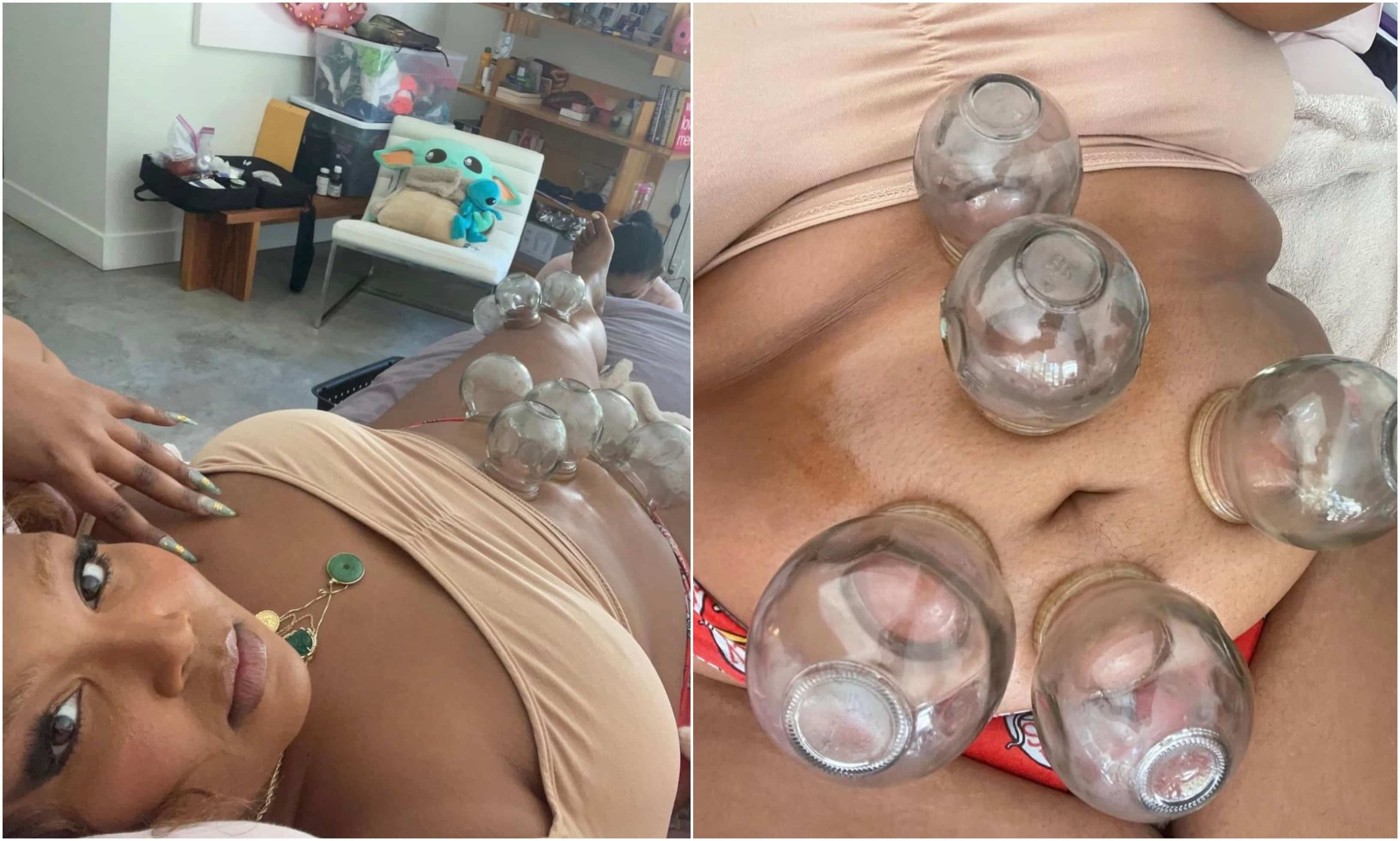 Tout sur le «cupping», la dernière lubie des stars