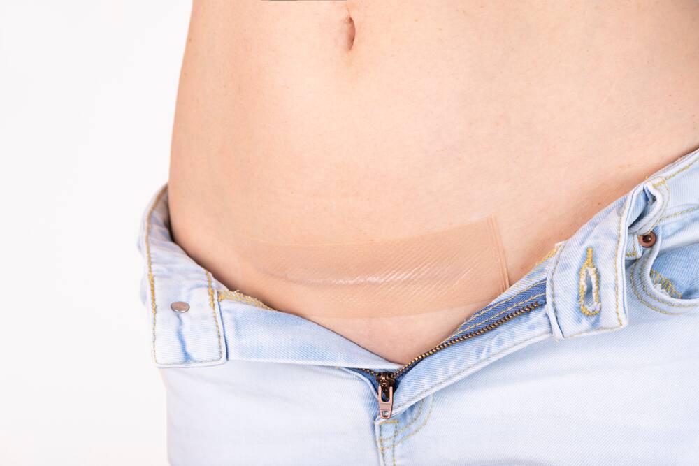 Le pouvoir régénérant des pansements en silicone