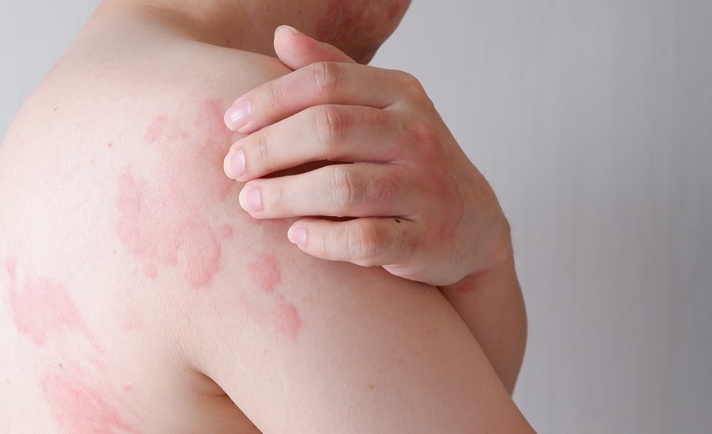 Causes et solutions pour 10 types de plaques rouges sur la peau | Salut ...