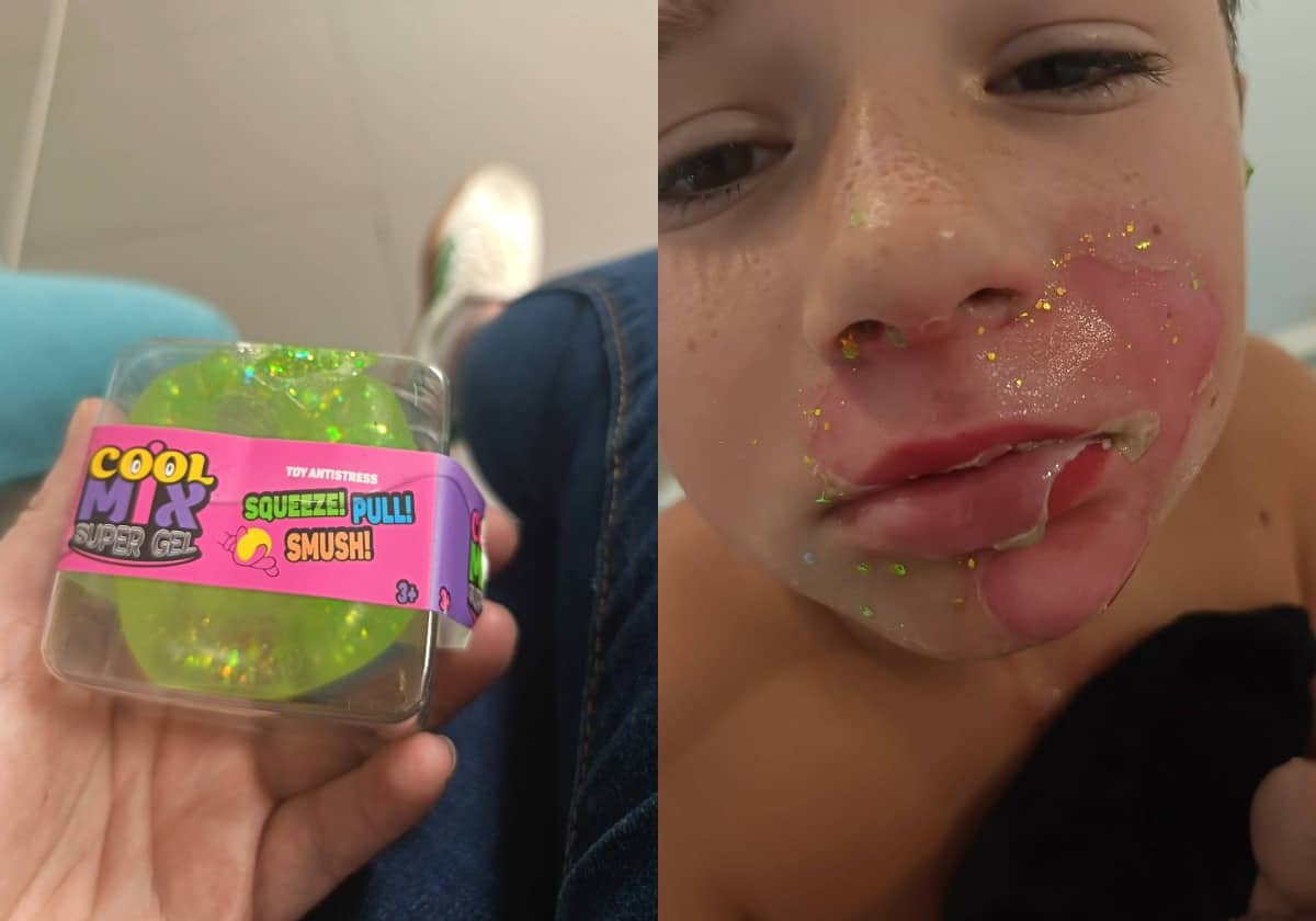Un jouet «squishy» explose et brûle le visage d’un enfant de 8 ans