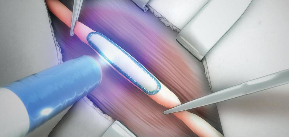 Surgery without stitches, a young company’s bet